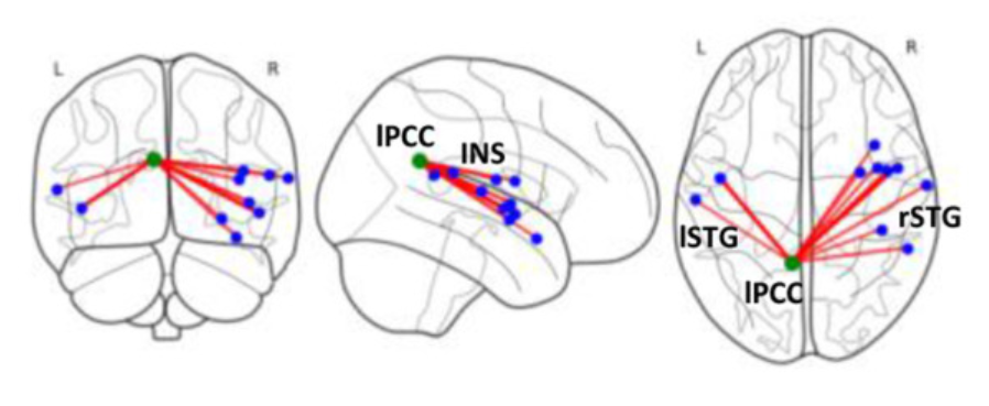 Kambeitz-Ilankovic_et_al_2020_modelling_sensory_processing.png