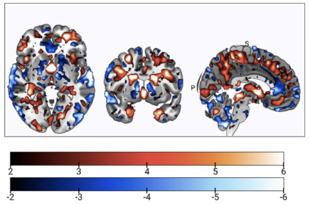 Kambeitz-Ilankovic_et_al_2021_multivariate_sMRI.png